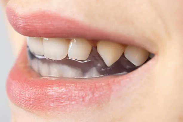 bruxism